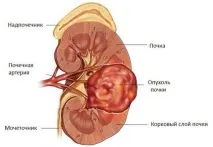 Пухлини нирки причини, симптоми, лікування та прогнози причини