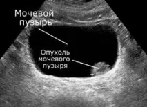 тумор тумор