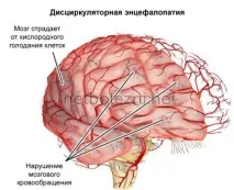 Осередкові зміни речовини мозку дисциркуляторного характеру зміни