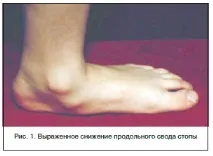 Плоскотопість малоінвазивна хірургія як альтернатива довічним супінаторам, Банецький М альтернатива