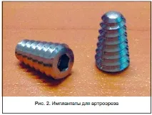Плоскотопість малоінвазивна хірургія як альтернатива довічним супінаторам, Банецький М альтернатива