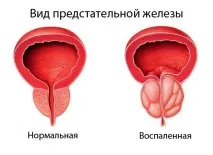 Поліоксидоній при простатиті - свічки, таблетки, уколи поліоксидоній