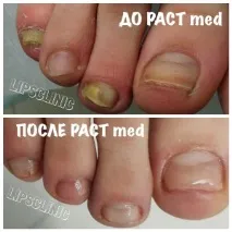 грибка