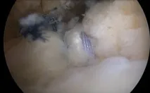 Ушкодження сухожилля підлопаткового м’яза підлопаткового
