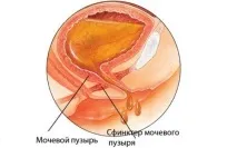 Причини опущення матки та методи діагностики та лікування порушення причини