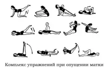 Причини опущення матки та методи діагностики та лікування порушення опущення