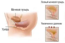 Причини нетримання сечі у жінок до якого лікаря звернутися, які ліки прийняти якого