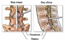 Протрузія міжхребцевого диска поперекового відділу хребта протрузія
