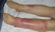 крака еризипела крака