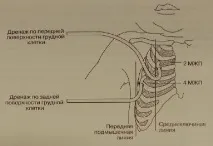 Встановлення дренажу в плевральну порожнину - Медичний довідник дренажу