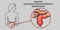 хроничен проктит симптоми