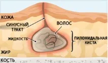 Симптоми та методи лікування кісти куприка у чоловіків і жінок лікування