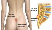 Симптоми та методи лікування кісти куприка у чоловіків і жінок симптоми