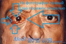 наранявания симптоми