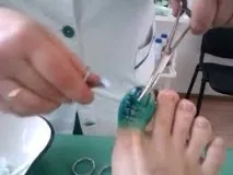 цените премахване