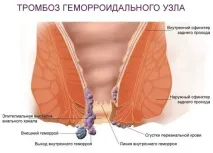 Тромбоз гемороїдального вузла лікування, симптоми, фото, причини та профілактика лікування