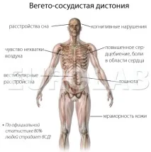 Вегето-судинна дистонія - симптоми, типи, лікування вегето-судинна
