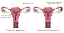 фалопиевата тръба извънматочна