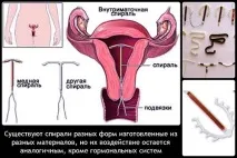 Внутрішньоматкові спіралі з цінних металів, золота та срібна внутрішньоматкова спіраль. внутрішньоматкові