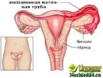 Запалення яєчників - Lady Citytile citytile
