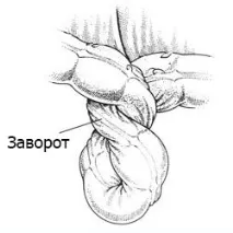 Заворот кишок симптоми та лікування народними засобами кишок