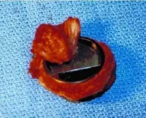 Ведення пацієнта після хірургічного втручання на клапанах пацієнта