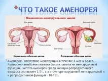 аменорея аменорея