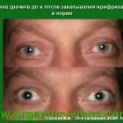 A новий метод для diagnosis of glaucoma glaucoma