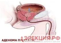 Аденома простати та ерекція лікування