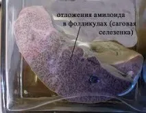 Амілоїдоз симптоми, лікування, опис симптоми