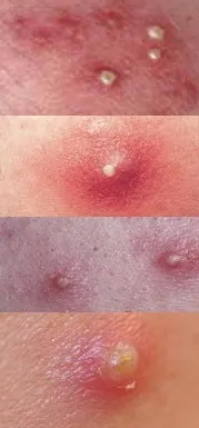 абсцес абсцес