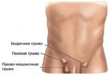 Біль у паху справа або зліва у чоловіків - причини болю, що тягне справа