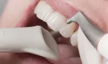 Чистка зубів Air Flow Що таке, методика, протипоказання flow