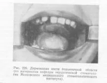 Дермоидна киста устната кухина