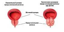 Ефективність лікування простатиту п’явками лікування