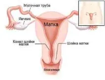 здраве ендоцервицит