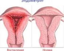 маточната кухина ендометрит
