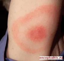 еритема кърлежи