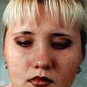 Фото демодекозу та відео про демодекс, картинки відео