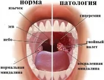 хемангиом методи