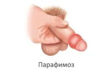 Гіпертрофічний фімоз у хлопчиків, лікування дітей з гіпертрофічним фімозом хлопчиків
