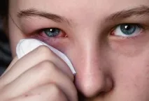 Очі червоні ефективні методи усунення подразнення білка очного яблука червоні