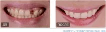 импланти зъбните