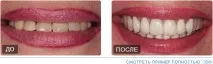 импланти фалшиви