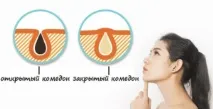 Як позбутися комедонів на обличчі позбутися