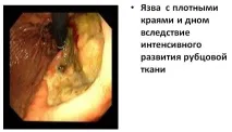 безчувствена стомаха