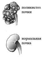 Кіста нирки у новонародженого – небезпечна для життя нирки