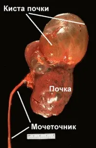 Кіста нирки у новонародженого – небезпечна для життя небезпечна
