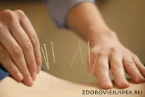 Китайське голковколювання китайське