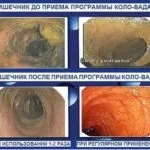 Коло Вада від глистів інструкція із застосування у лікуванні паразитів вада